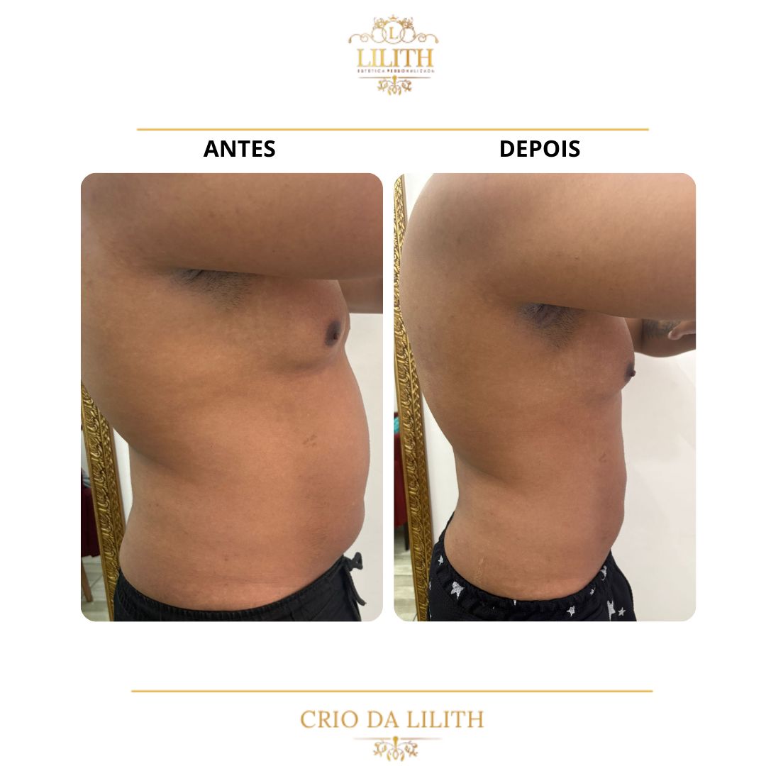 Resultado de criolipólise - redução de gordura abdominal