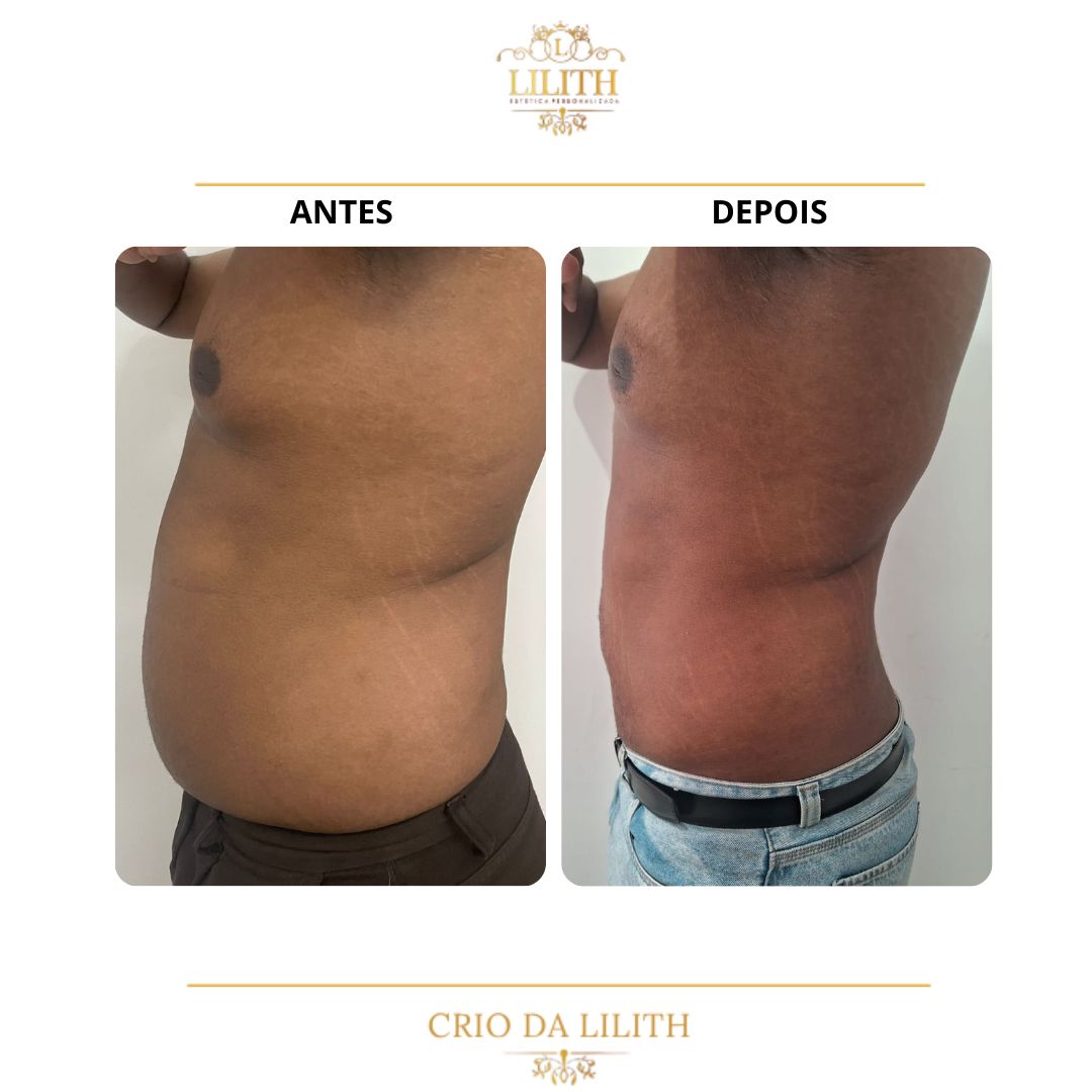 Resultado de criolipólise - redução de gordura lateral