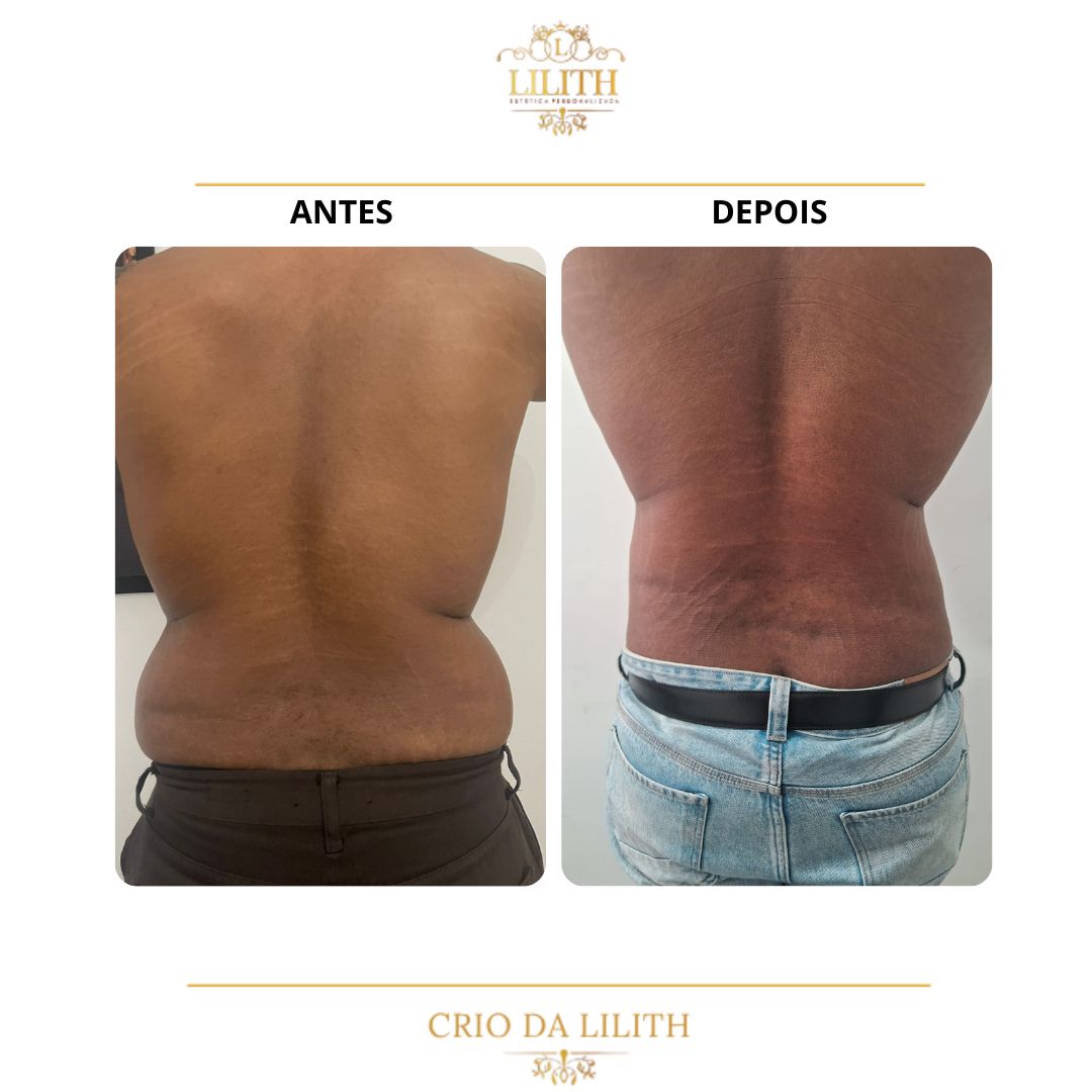 Resultado de criolipólise - redução de gordura nas costas