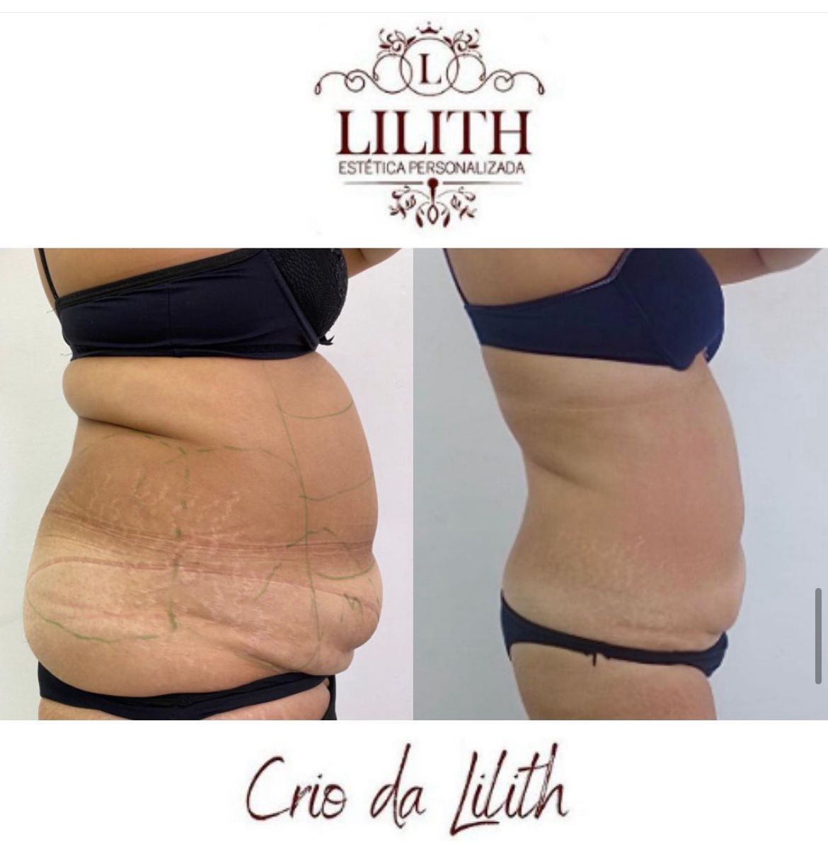 Resultado de criolipólise - transformação abdominal