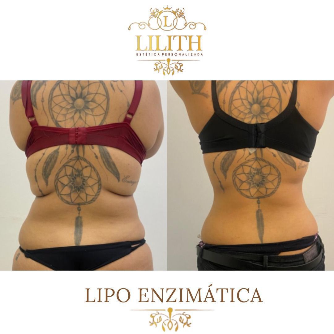 Resultado de lipo enzimática - redução de gordura nas costas